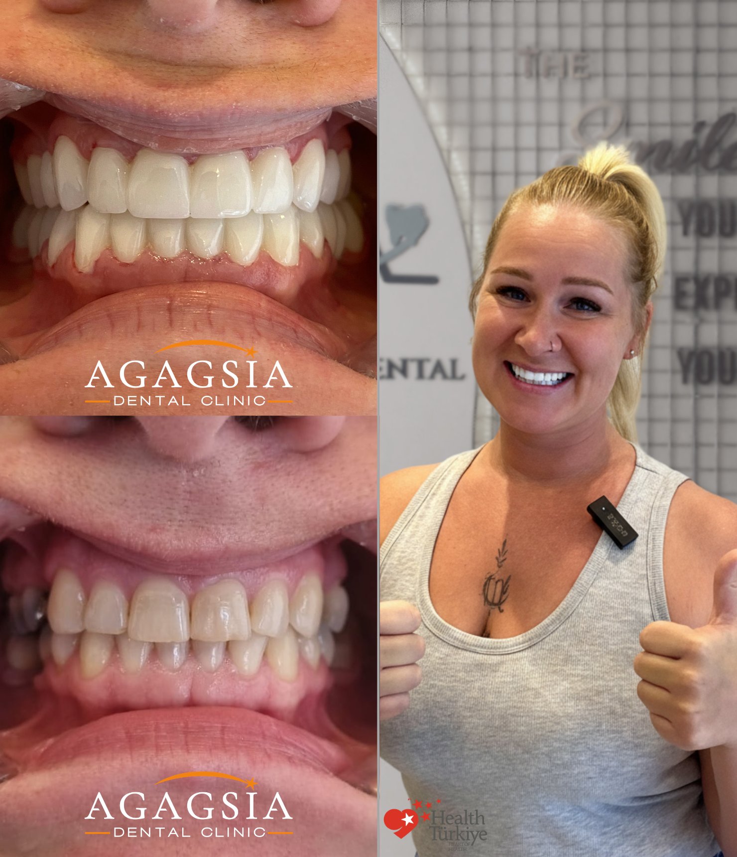 Agnese — Hollywood Smile vakası